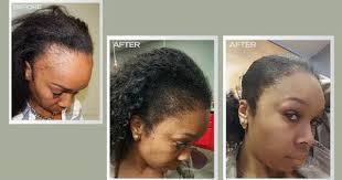 Best Female Hair Transplant Before And After Hair Loss Traction Alopecia In Women Ta Hair Transplant Women Alopecia Women Hair Transplant Before And After