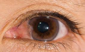 Gozde Et Yurumesi Pterjium Op Dr Fersat Muhacir