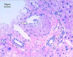 Computed Tomography Findings Of Hepatic Veno Occlusive Disease Caused By Sedum Aizoon With Histopathological Correlation