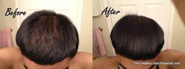 Be sure that your hair and scalp are dry. Our Hair Loss Diet Completely Reverses Hair Thinning And Balding