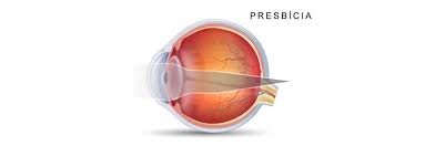 Image result for Presbyopia
