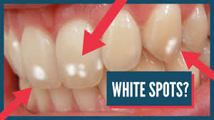 Teeth discolor with age because the core tissue of the teeth, the. What Do White Spots On Your Teeth Mean How To Get Rid Of Them