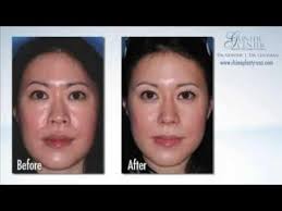 Asian Rhinoplasty
