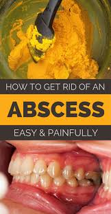 🎧 subscribe to our channel and stay up to date with the latest videos!click here: How To Get Rid Of An Abscess Painless And Naturally Cold And Cough Remedies Natural Cures Tooth Infection