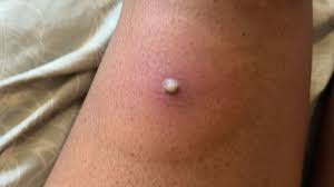 Image result for ant bite
