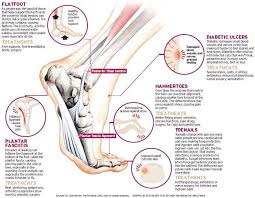 Pin On Bone Spurs Feet