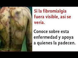 Puntos importantes sobre la fibromialgia. Los Sintomas De La Fibromialgia Que No Debes Dejar Pasar Que Es La Fib Sintomas De Fibromialgia Fibromialgia Sintomas De La Fibromialgia