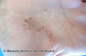 Image result for Pustular Psoriasis