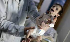 Very thin and weak, usually because of illness or extreme hunger: Images Of Emaciated Syrian Child Shocking Un Egypttoday