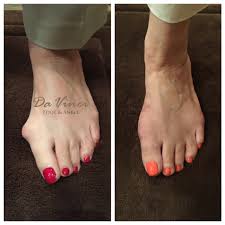 But these tips are helpful. Bunion Surgery Augusta Removal Treatment Bunionplasty Podiatrist Near Atlanta Greensboro Thomson Da Vinci Foot And Ankle