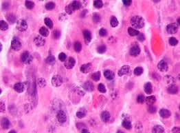 In multiple myeloma, t(4;14)(p16;q32) is an adverse prognostic factor irrespective of fgfr3 expression. Multiple Myeloma Wikipedia