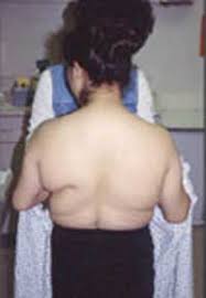 Image result for Lipodystrophy