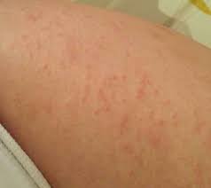 Bumps on the arms are pretty common. Itchy Bumps On Arms Pictures Symptoms Causes Treatment