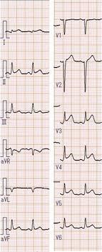Myocarditis (mk) is a cardiovascular disease characterized by heart muscle damage due to the development of inflammation in the tissues of the the most frequent ecg signs of myocarditis A Case Report Of Myocarditis Combined With Hepatitis Caused By Herpes Simplex Virus Bmc Cardiovascular Disorders Full Text
