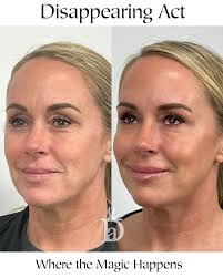 Finding a provider who can customize a treatment plan specifically for you  and then safely implement it is what we do at Disappearing Act 💜 This  gorgeous patient came in requesting a