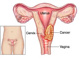 Uterine cancer (also called endometrial cancer) is a serious condition that affects millions of women annually. Signs And Symptoms Of Uterine Cancer Treatment And Risk Factors Article Ritz