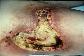 Apr 19, 2021 · necrosis is the disorganized breakdown of flesh in some part of the body of a multicellular organism. Chronic Effects Tissue Necrosis Radiation Emergency Medical Management