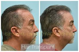 This 60-year-old man is shown before and one year after a hair transplant  procedure. #dallashairtransplant #hairtransplant #hairtransplantsurgery  #hairtransplantation #hairtransplantresults #hairtransplantdallas  #hairtransplantresult #dallashairsurgeon ...