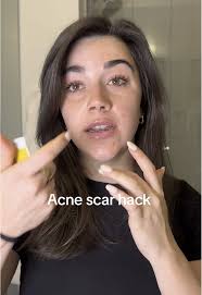 Neosporin: El Cambio de Juego para las Cicatrices de Acné