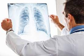 Kebanyakan kes tonsil bengkak disebabkan oleh jangkitan kuman. Jangkitan Kuman Di Paru Paru Lung Infection Simptom Doctoroncall