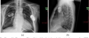 Icd ( implantable cardiac defibrillator) on the other hand senses a very fast or chaotic rhythm, known as ventricular fibrillation, and gives an electrical. Figure 13 From Adverse Interactions Between Icd And Permanent Pacemaker Systems Semantic Scholar