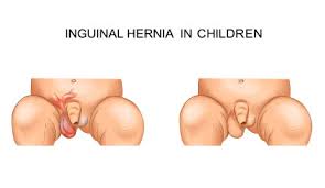 Image result for Inguinal hernia child