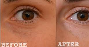 The Small White Bumps On Your Skin Which Usually Appear Around Your Nose Cheeks Or Eyes Are Called Mi Bumps Under Eyes Skin Tag On Eyelid Skin Care Treatments