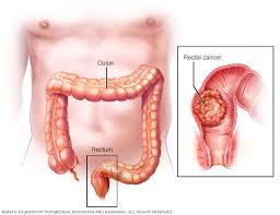 Chronic fatigue in colon cancer can develop as a result of depleting energy sources, loss of muscle mass and internal blood loss from the disease itself. Rectal Cancer Symptoms And Causes Mayo Clinic