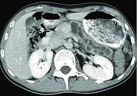 Image result for Helical CT Urogram