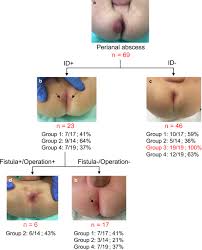 Image result for Perianal Abscess