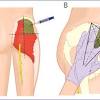 The sciatic nerve runs under the gluteus maximus. 1