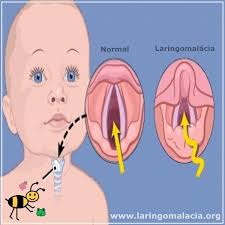 It's an abnormality in which the tissue just above the vocal cords is especially soft. Vivendo Com Laringomalacia Fotos Facebook