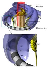 Looking for online definition of modiolus in the medical dictionary? Figure 1 Modiolus Hugging Intracochlear Electrode Array With Shape Memory Alloy