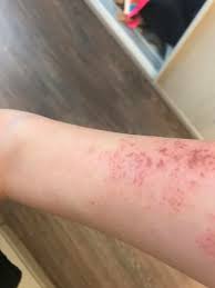 Tahris Olmus Koltuk Altina Ne Iyi Gelir