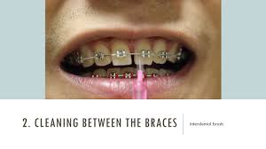 Brushing teeth with braces isn't too different than brushing without braces. How To Care For Your Teeth When You Have Braces
