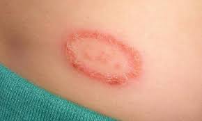 It just made my ringworms red and created little scabs. How To Treat Ringworms Home Remedies For Ringworm Essential Oils For Ringworm Ringworm Remedies