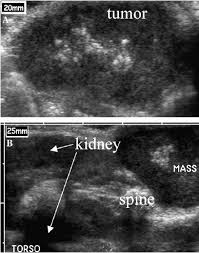 This is a network of thin tubes (vessels) and nodes that carry a clear fluid called lymph around the body. B Mode Ultrasound Images Of Mda Mb231 Human Breast Cancer Tumors In Download Scientific Diagram