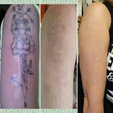 Apply a mixture of salt and lemon to remove the tattoo. Tattoo Removal Techniques Dallas Plano Frisco Addison Derma Aesthetic And Laser Center