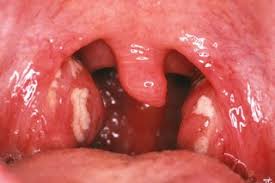 Image result for Tonsillitis