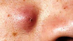 Jun 11, 2021 · berkat kemampuannya untuk menjaga kelembapan dan menenangkan kulit, squalane oil akan sangat berguna untuk pemilik kulit kering atau orang kondisi kulit tertentu, misalnya eksim. Tips Membasmi Jerawat Dan Kulit Kering Sekaligus Pos Belitung