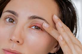 Image result for Eye Pain