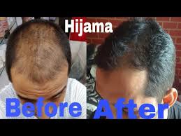 However, hijama does not promise you anything. Hair Fall Baldness Ganjapan à¤¬ à¤² à¤• à¤Ÿ à¤Ÿà¤¨ Treatment By Hijama Cupping Therapy 7017194019 Ø¯ÛŒØ¯Ø¦Ùˆ Dideo