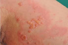 3 a person's chance of developing graves' disease increases if other family members have the disease. Pemphigoid Gestationis Current Perspectives Ccid