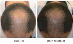 Derms have long been using microneedling to rejuvenate the face, now they're going further, and using it on your scalp for hair loss. Microneedling For Hair Loss What S The Best Needle Length It Depends