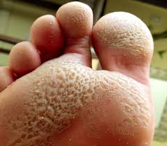 Image result for Pitting nails feet