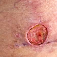 Image result for wolf spider bite skin