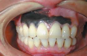 Image result for gums cancer symptoms