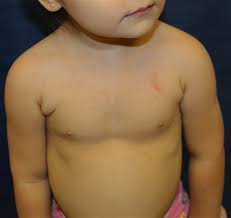 Image result for Urticaria pigmentosa children