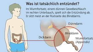 Organe Der Blinddarm Ist Gar Nicht So Nutzlos Wie Gedacht Welt