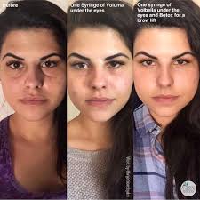This patient came in the 1st time to get rid of her under eye bags. Our  Nurse used 1 syringe of Voluma to fill the hollowness. Her results were so  amazing! 1